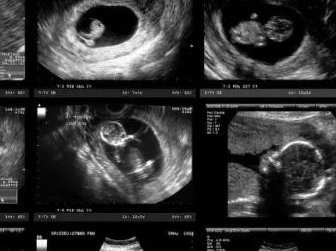 在咸宁市中心医院做试管婴儿要多少钱？成功率怎么样？附试管怀孕机构名单一览